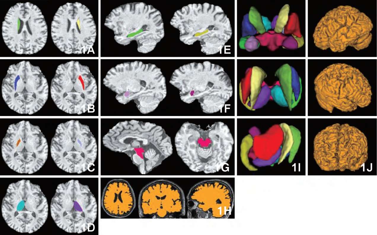 基于磁共振T1成像的帕金森病相关脑结构体积差异性分析